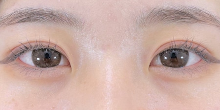 {クイックコスメティークダブル・NEO} {10代}  {女性} の術後の症例写真