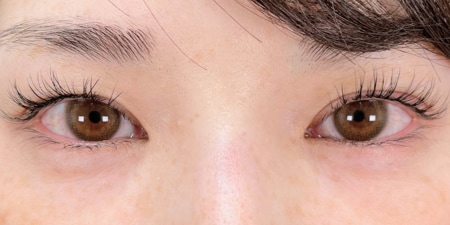 {FE自然癒着} {10代}  {女性} の術前の症例写真