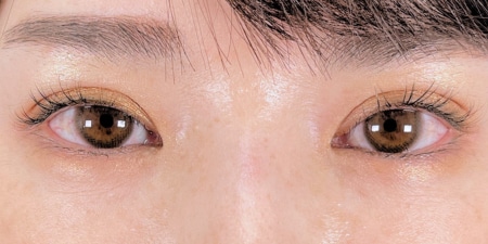 {FE自然癒着} {10代}  {女性} の術後の症例写真