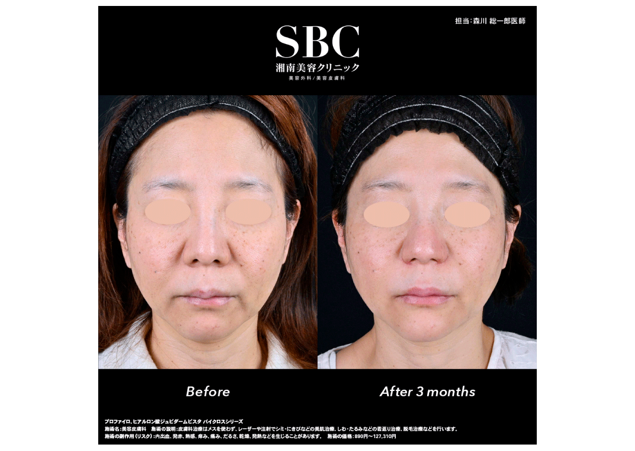 顔（目の下・頬・ほうれい線）