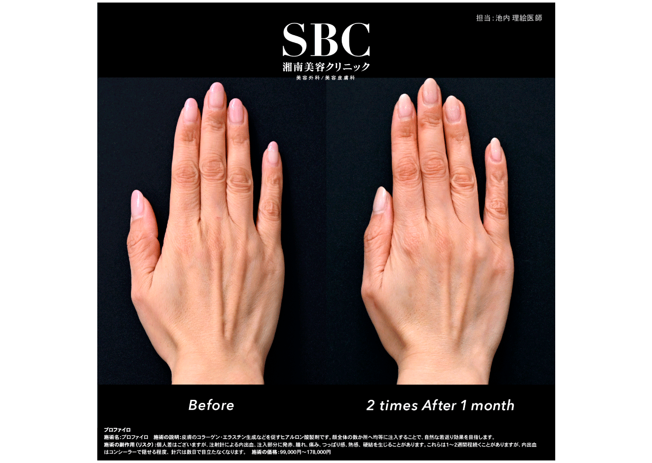 手の甲・その他の部位