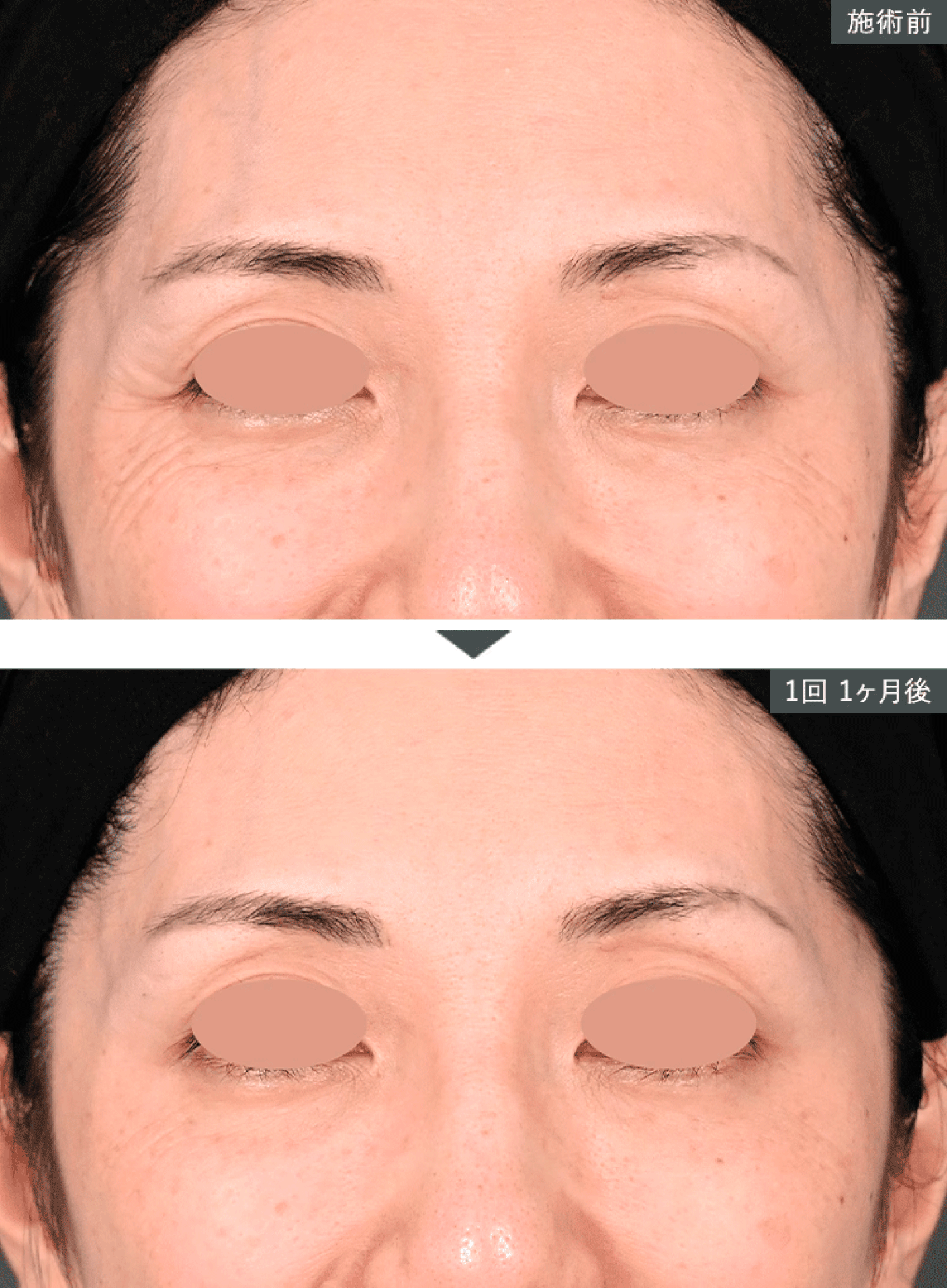 女優注射の効果はいつから？持続期間・回数まで完全ガイド - 流山おおたかの森院, image size:1431x1946