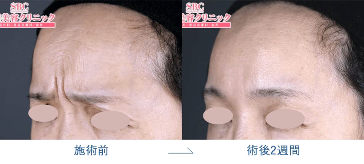 おでこ・眉間・目尻