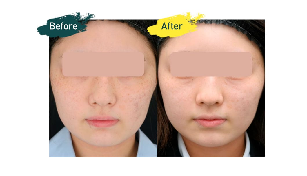 フォトジェネシス(顔・首・手の甲)