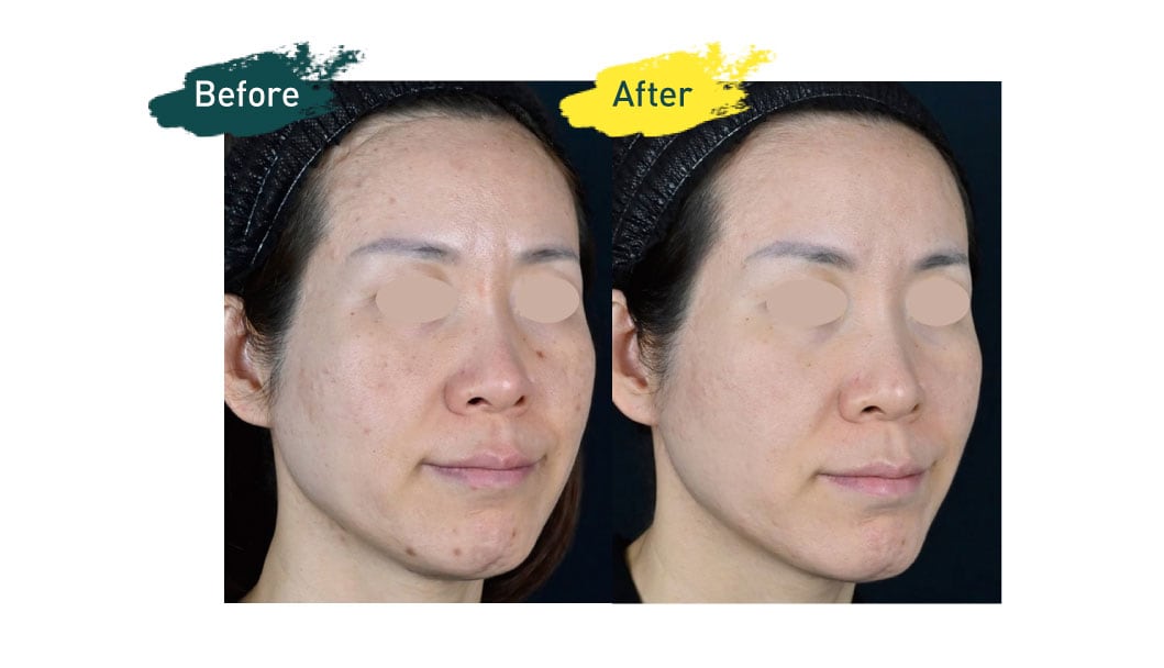 シルファームX(顔＋首)　5回