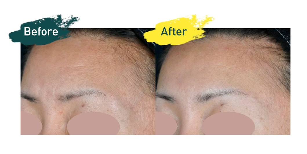 SBCトキシルスレッド　8本