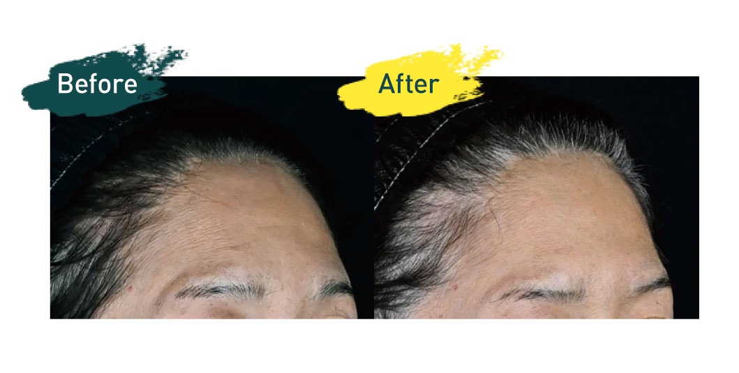 女優注射(リジュランiまたはリジュランHB＋ボトックス)　1本