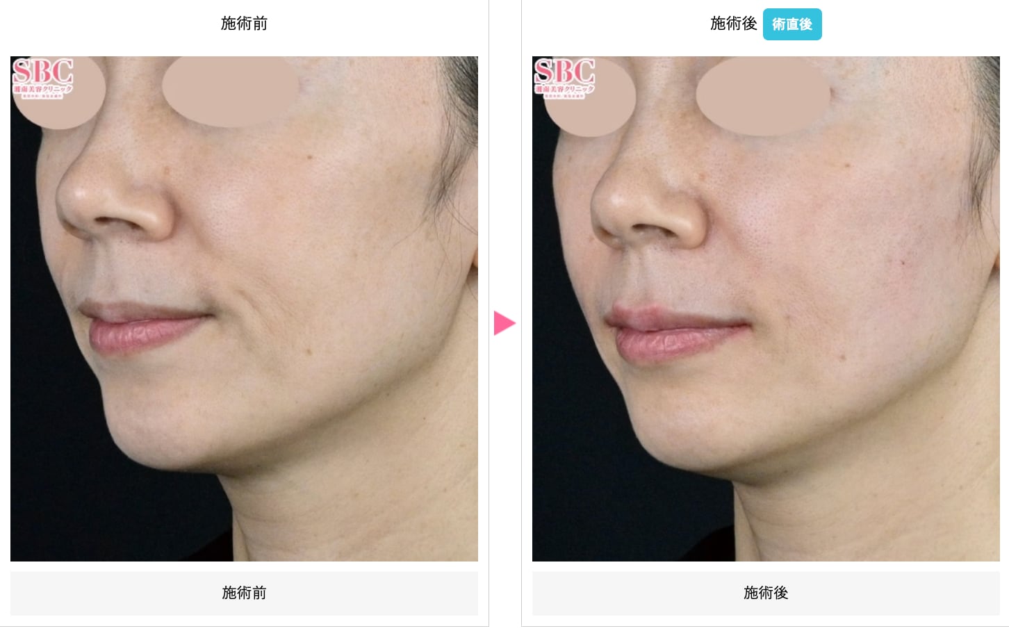 ヒアルロン酸【ジュビダームビスタバイクロスシリーズ】（アラガン社製）