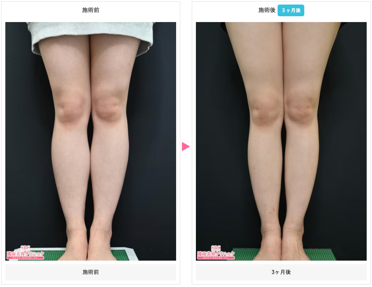 ふくらはぎボトックス