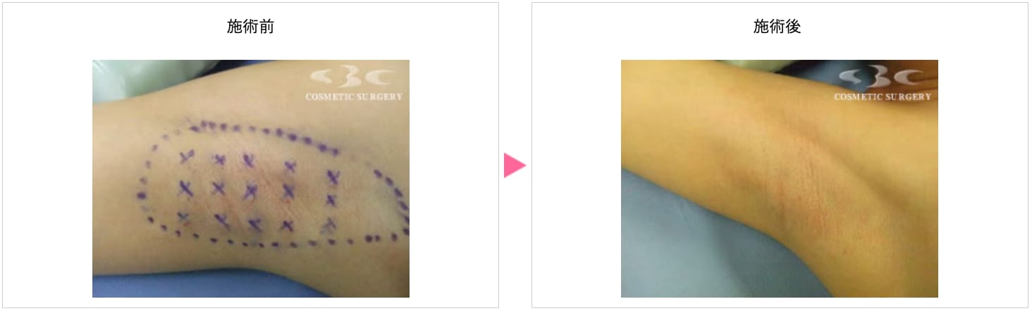 ワキの汗止め注射