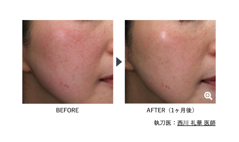 SKINVIVE/スキンバイブ(ジュビダームビスタ ボライトXC)<br />
