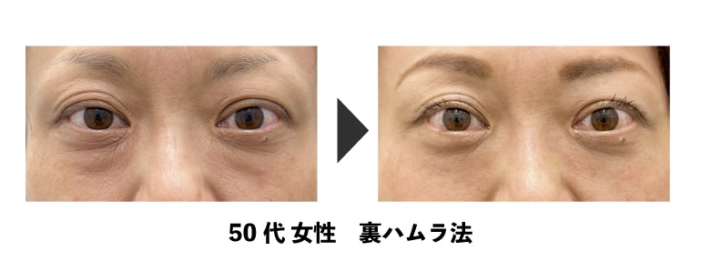 裏ハムラ法・切開ハムラ法<br />
