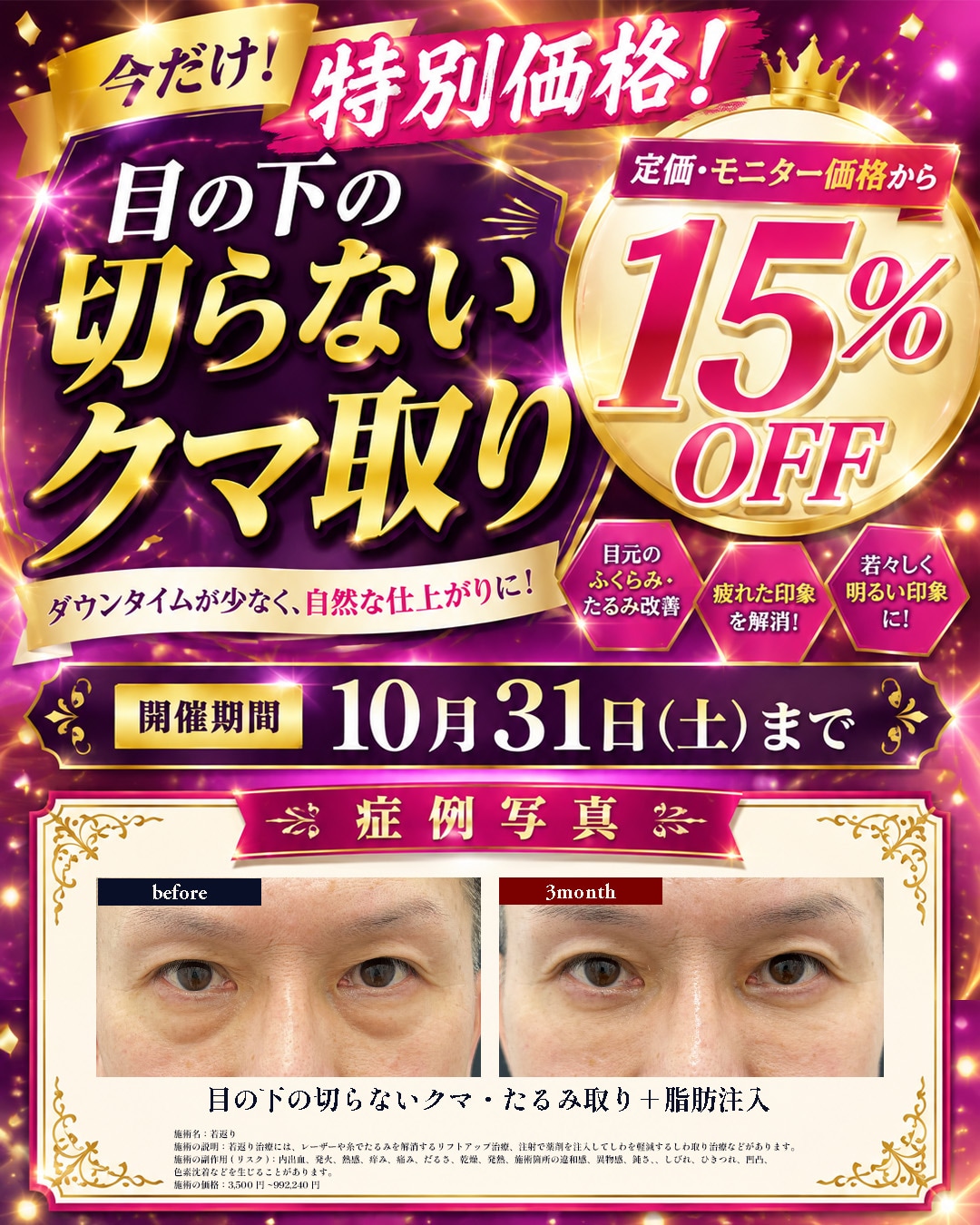 目の下の切らないクマ取り
