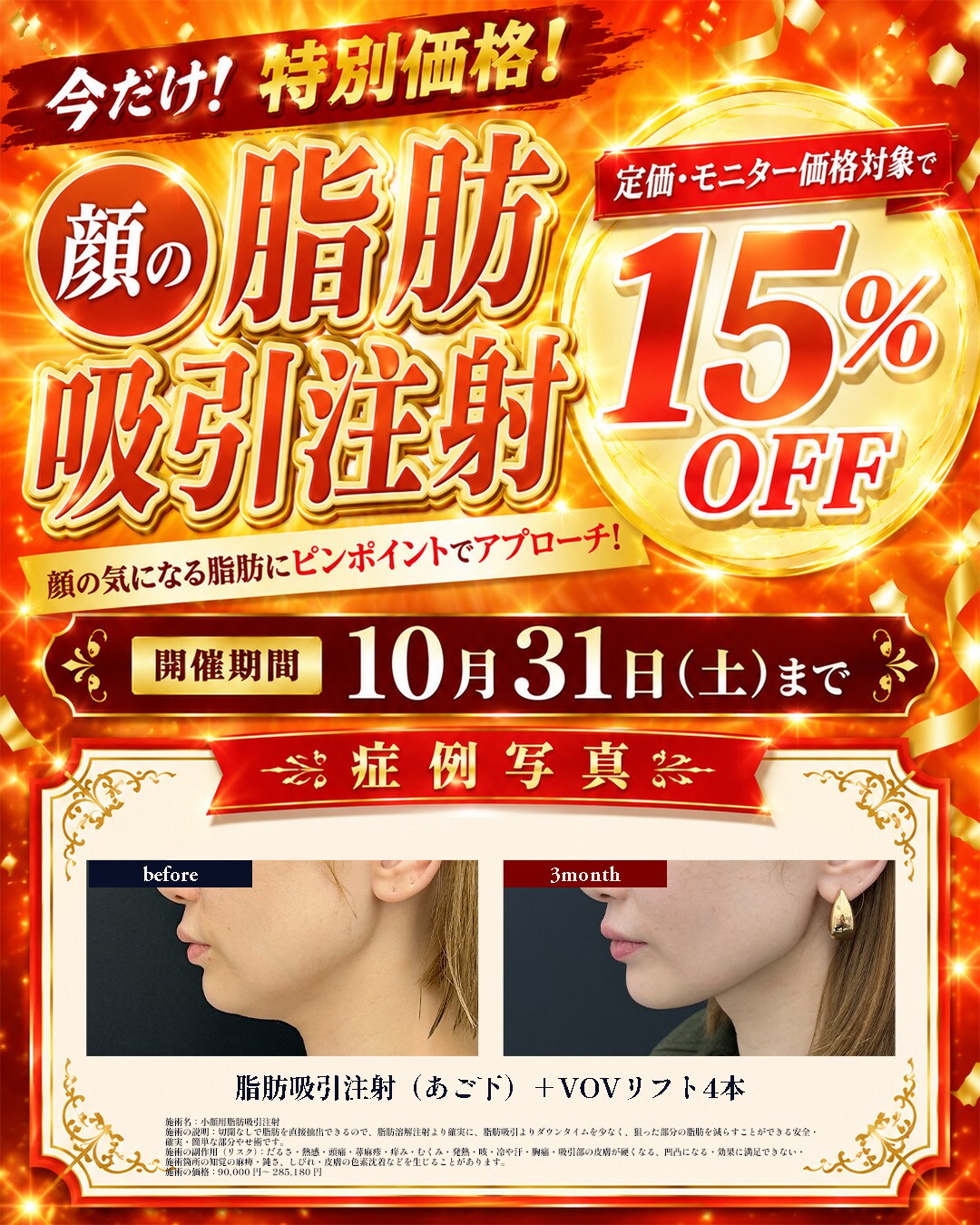 脂肪吸引注射【対象部位：顔】