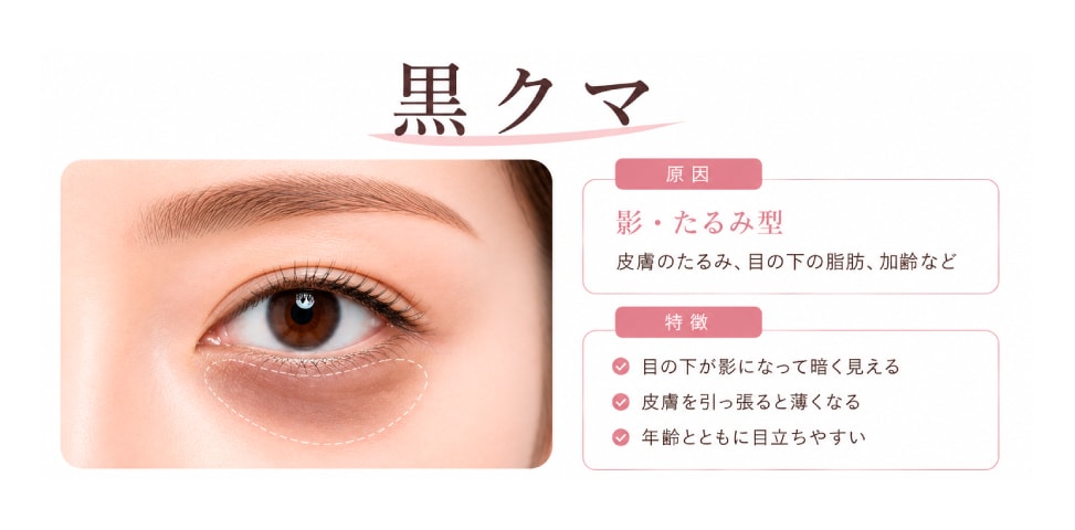 黒クマ（影・たるみタイプ）