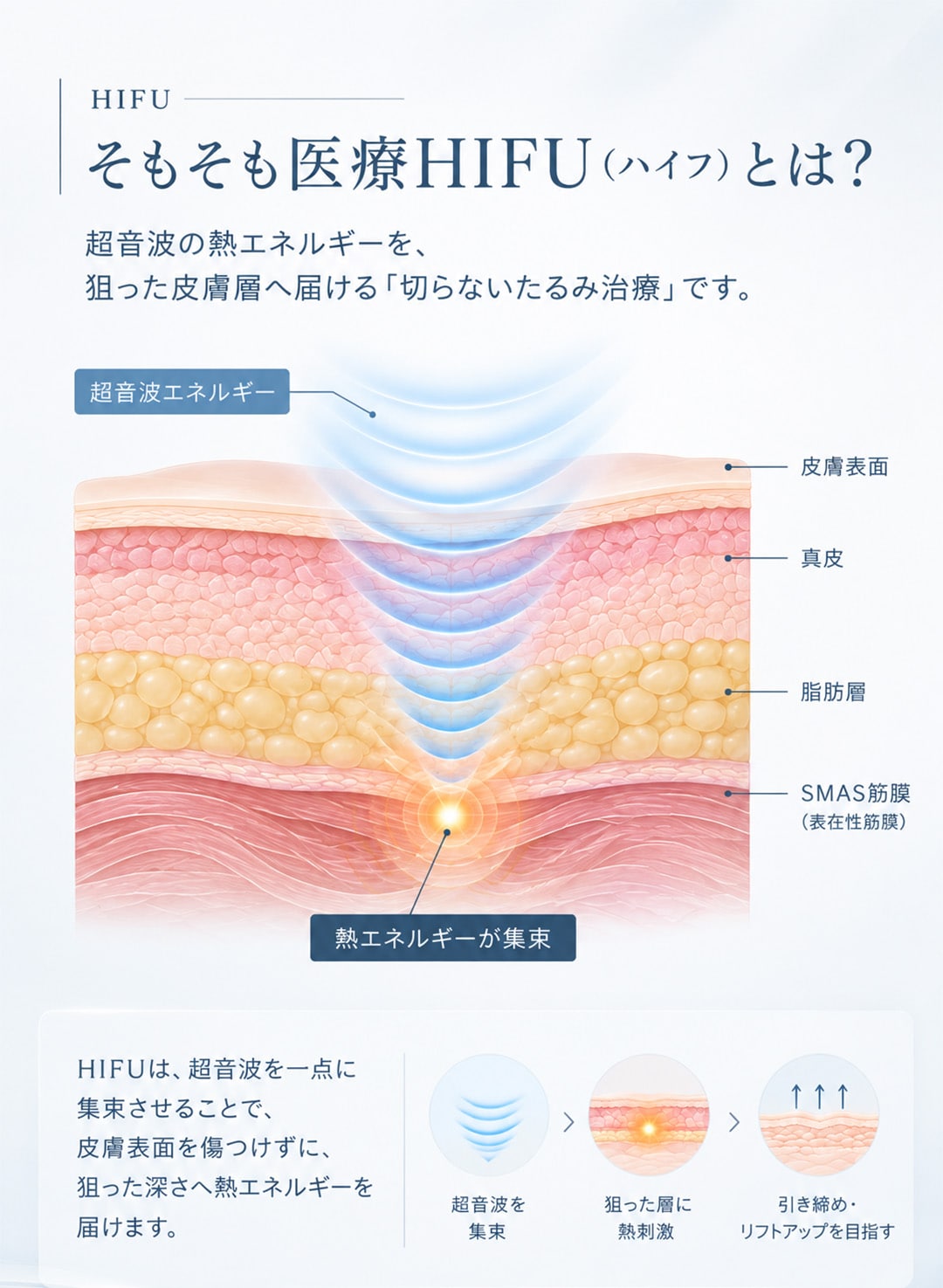 超音波の熱エネルギーを、狙った皮膚層へ届ける「切らないたるみ治療」<br />
