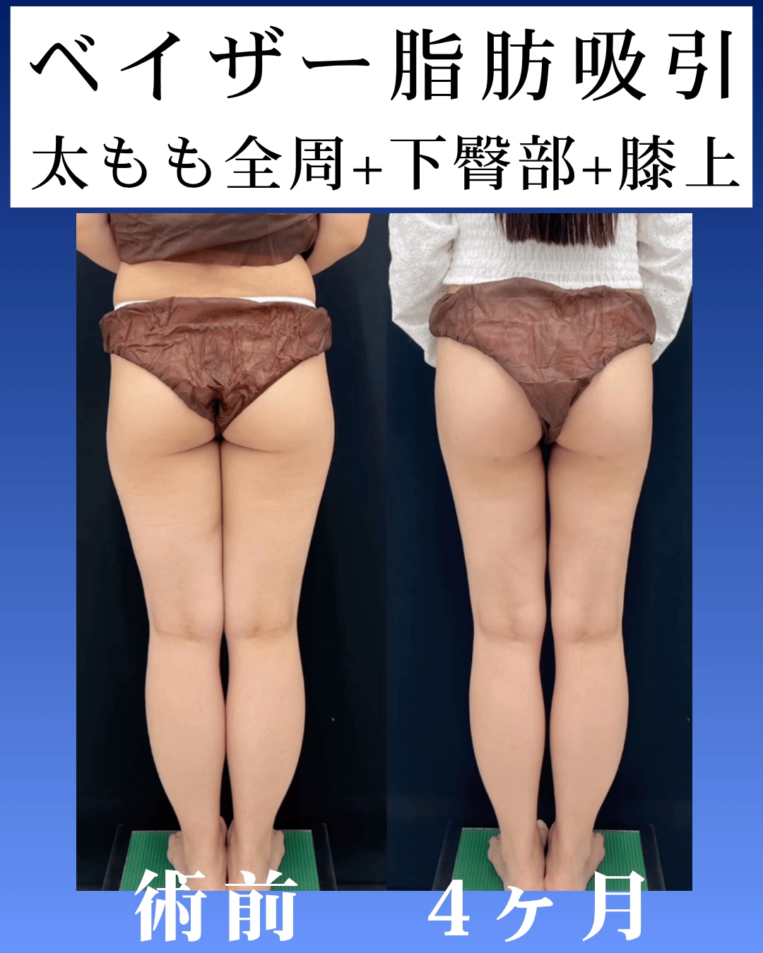 ベイザー脂肪吸引術後4ヶ月のモニター様