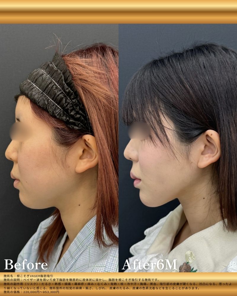 脂肪吸引術後6ヶ月のモニター様<br />
ほほ・あご下+ジョール+バッカル+糸リフト+アゴヒアルロン酸