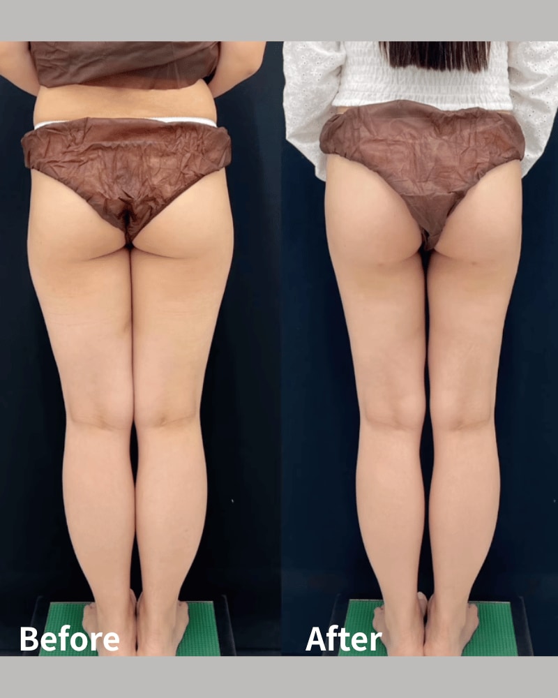 ベイザー脂肪吸引術後4ヶ月のモニター様<br />
太もも全周+下臀部+膝上
