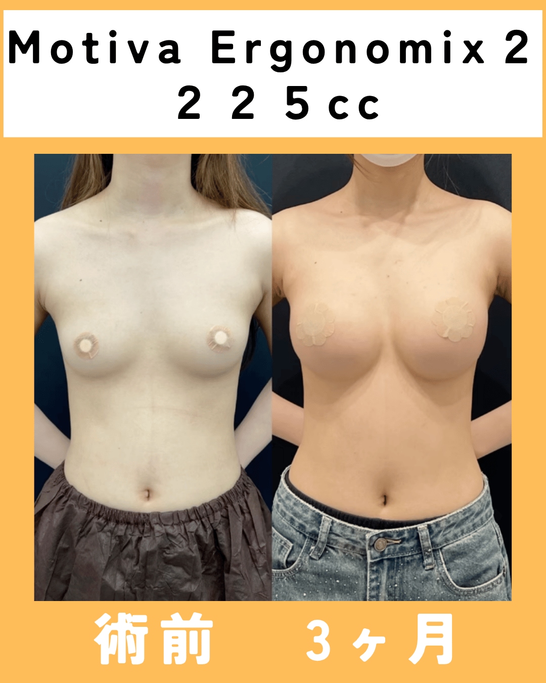 Motiva エルゴのミックス2豊胸術後３ヶ月のモニター様