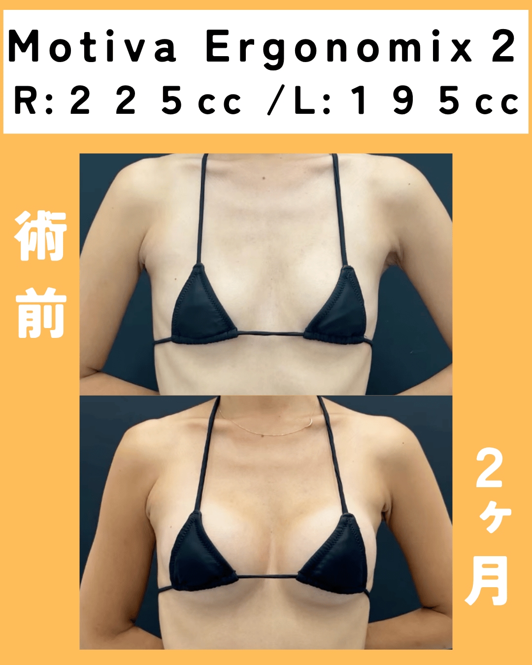 Motiva エルゴのミックス2豊胸術後２ヶ月のモニター様