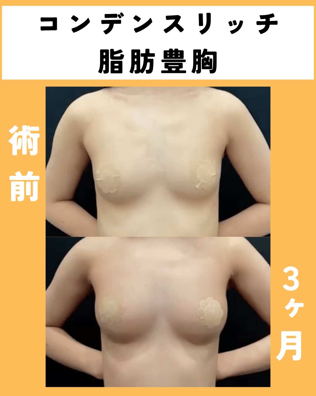 コンデンスリッチ脂肪注入豊胸術後３ヶ月のモニター様