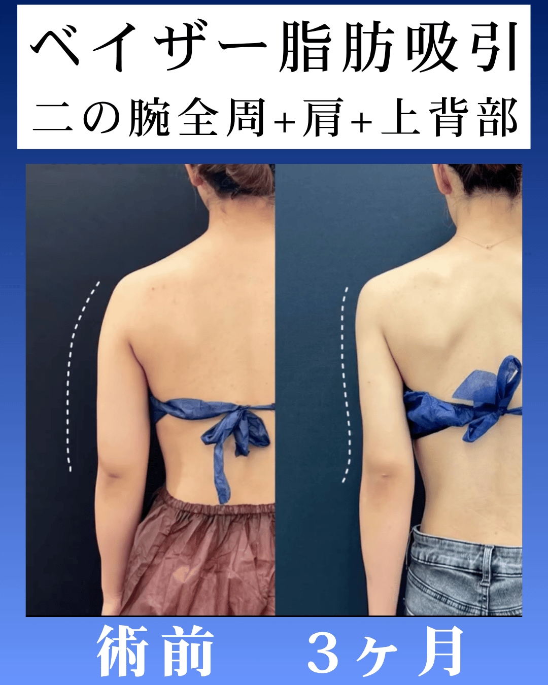 ベイザー脂肪吸引術後3ヶ月のモニター様