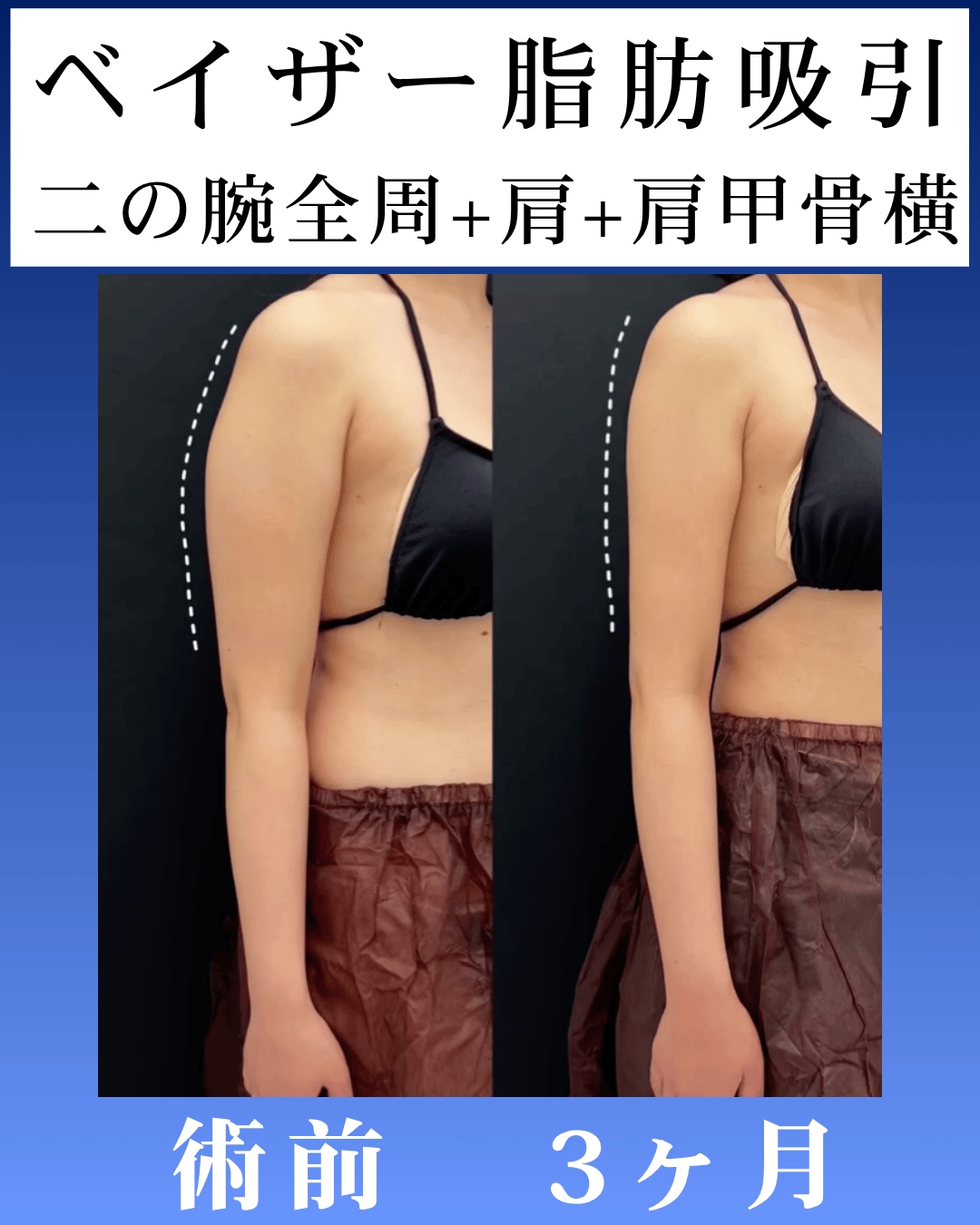 ベイザー脂肪吸引術後3ヶ月のモニター様