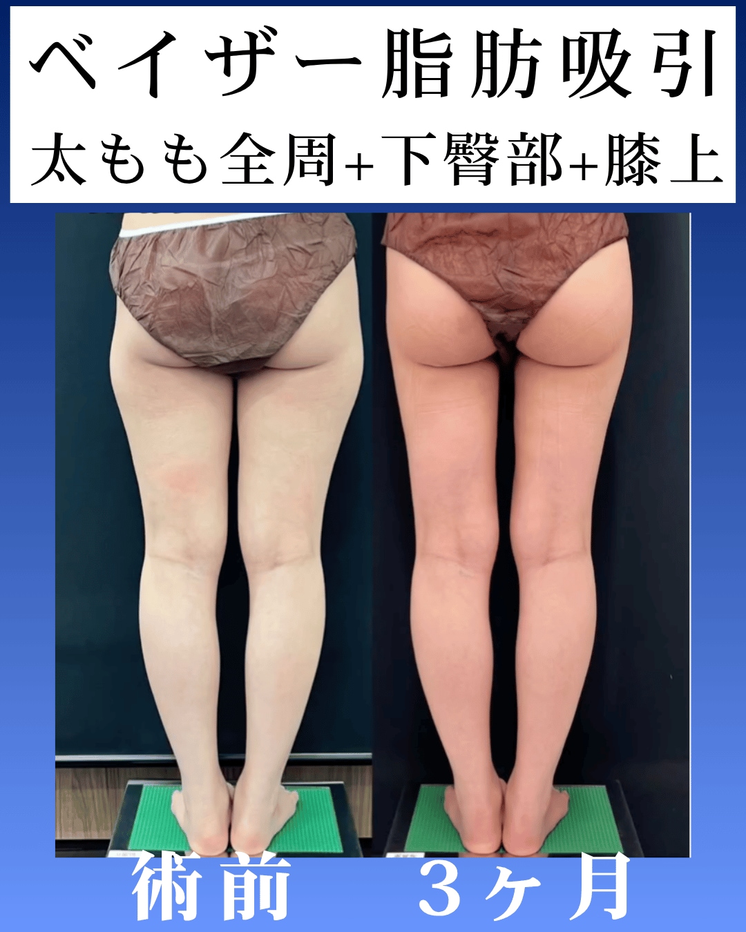 ベイザー脂肪吸引術後3ヶ月のモニター様