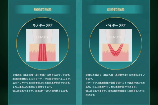 ポイント1:モノポーラ+バイポーラのモノバイ技術
