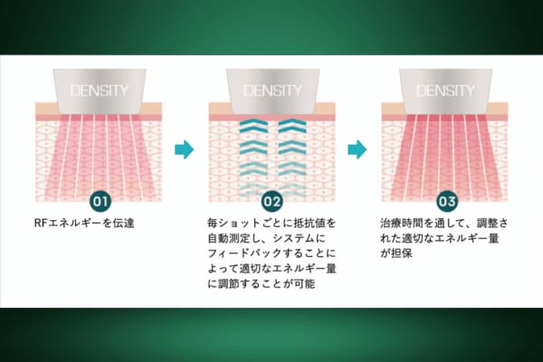 ポイント２：肌の状態を都度確認し、均一なエネルギーを照射