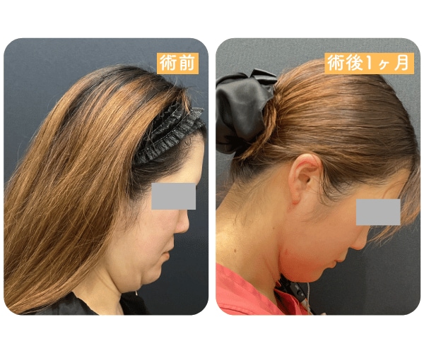 ビフォーアフター