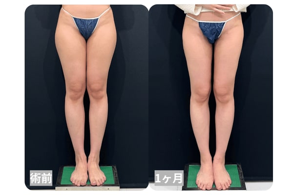 術後1ヶ月の変化