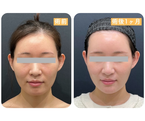 術後1ヶ月の変化