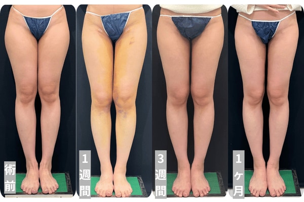 術前→1週間→3週間→1ヶ月