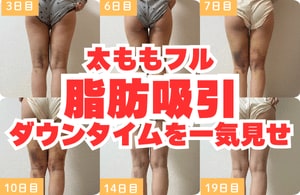 長崎で【脂肪吸引】といえばSBC長崎院！気になる太もものダウンタイムを一気見せっ♡