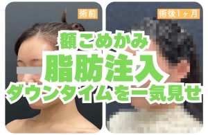 究極のエイジングケア。脂肪注入のダウンタイムを大公開！