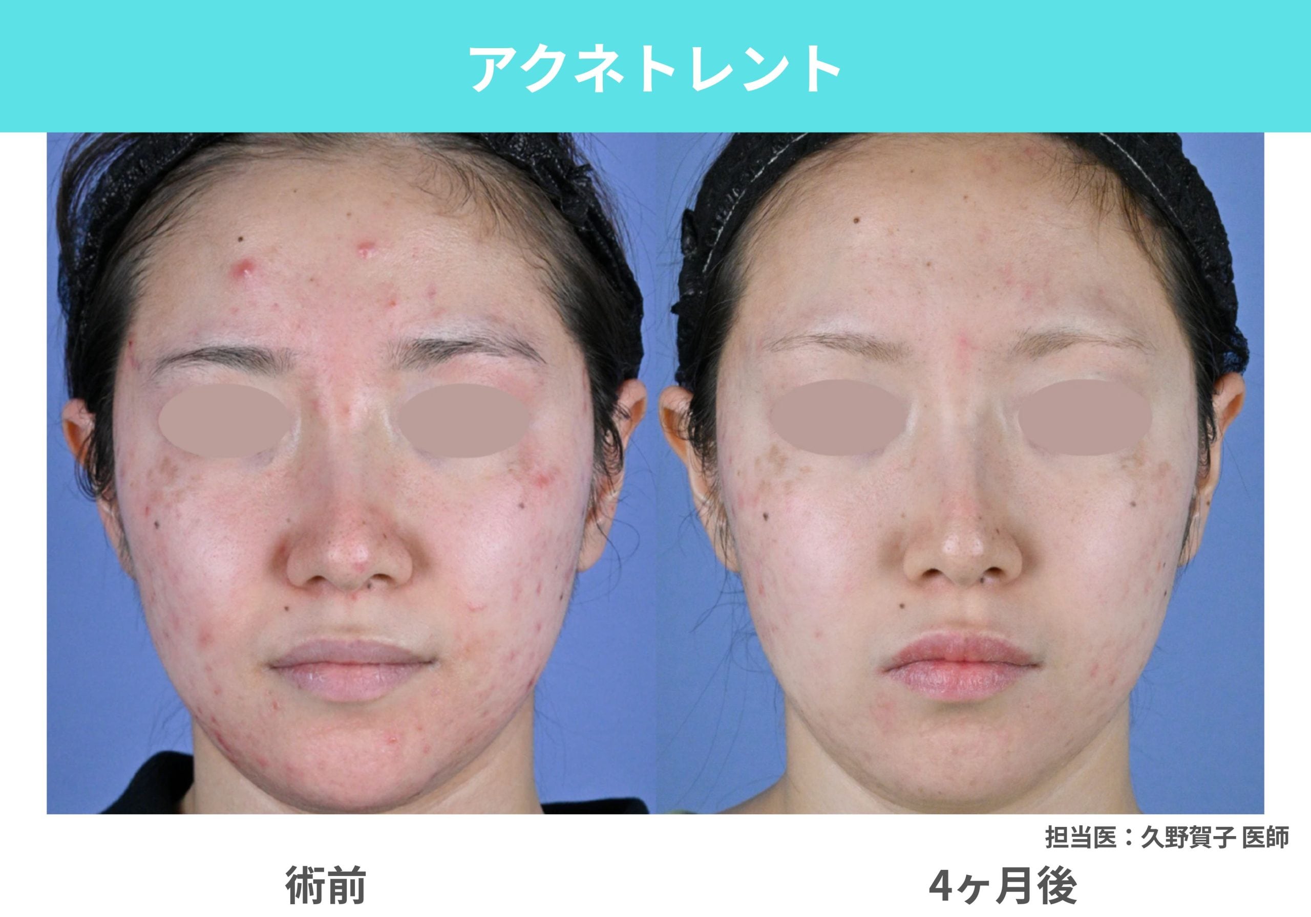 アクネトレント（内服薬） 【ニキビの連鎖を断つ】