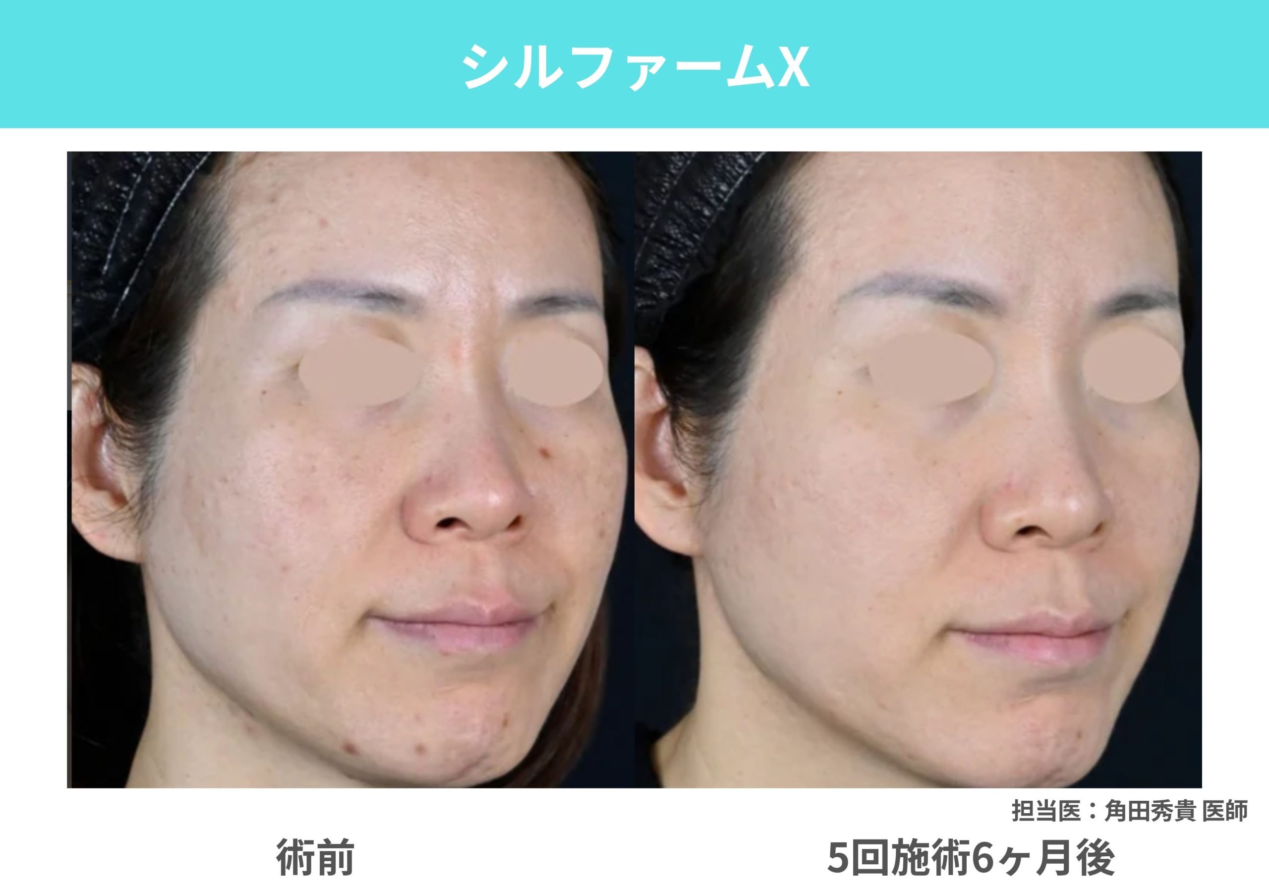 シルファーム（最新マイクロニードルRF） 【赤み・肌質改善】