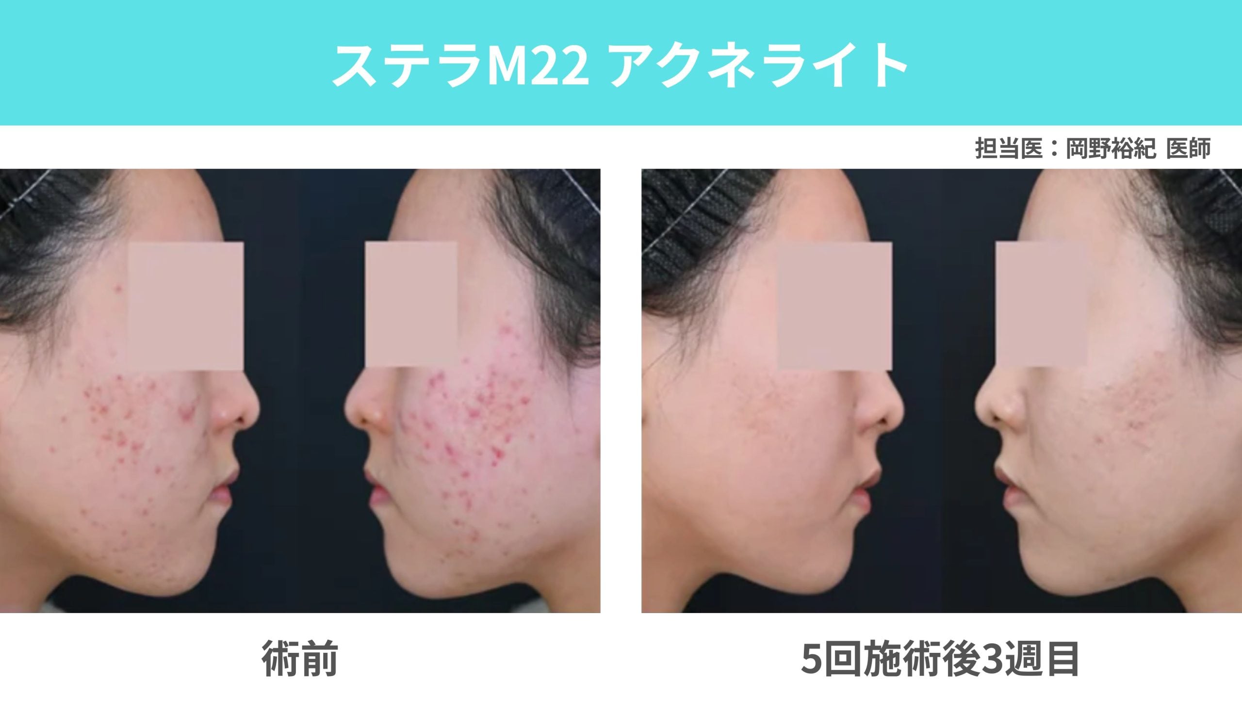 アクネライト【炎症・赤みを撃退】