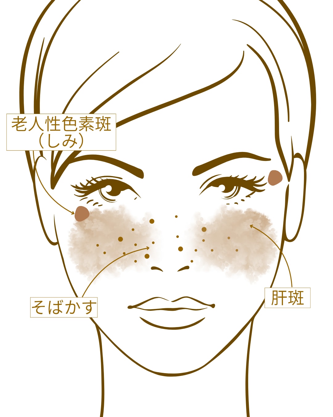 あなたのしみはどのタイプ？