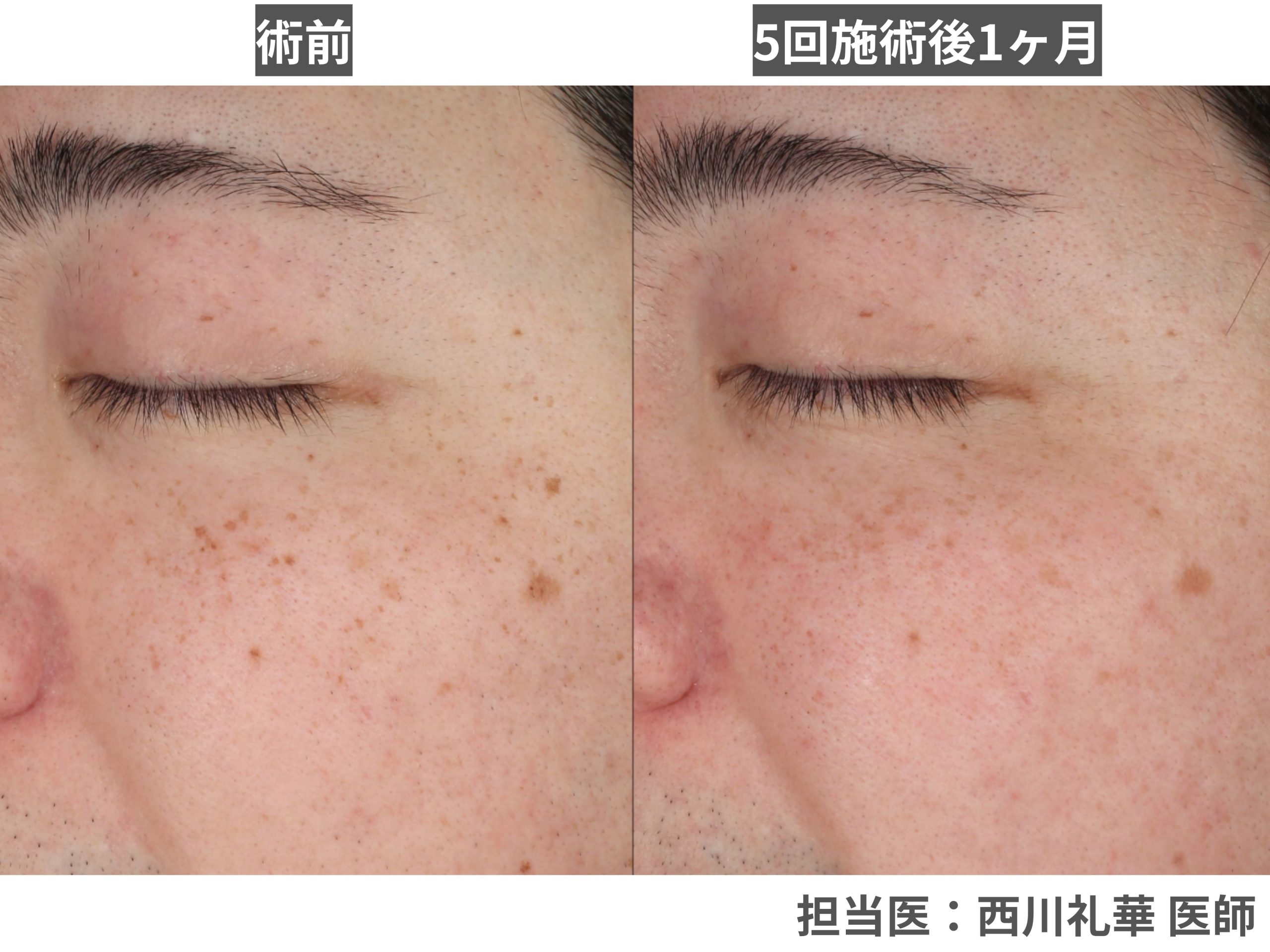 【そばかす】顔全体のくすみ・薄いしみを「マイルドに一掃したい」方へ