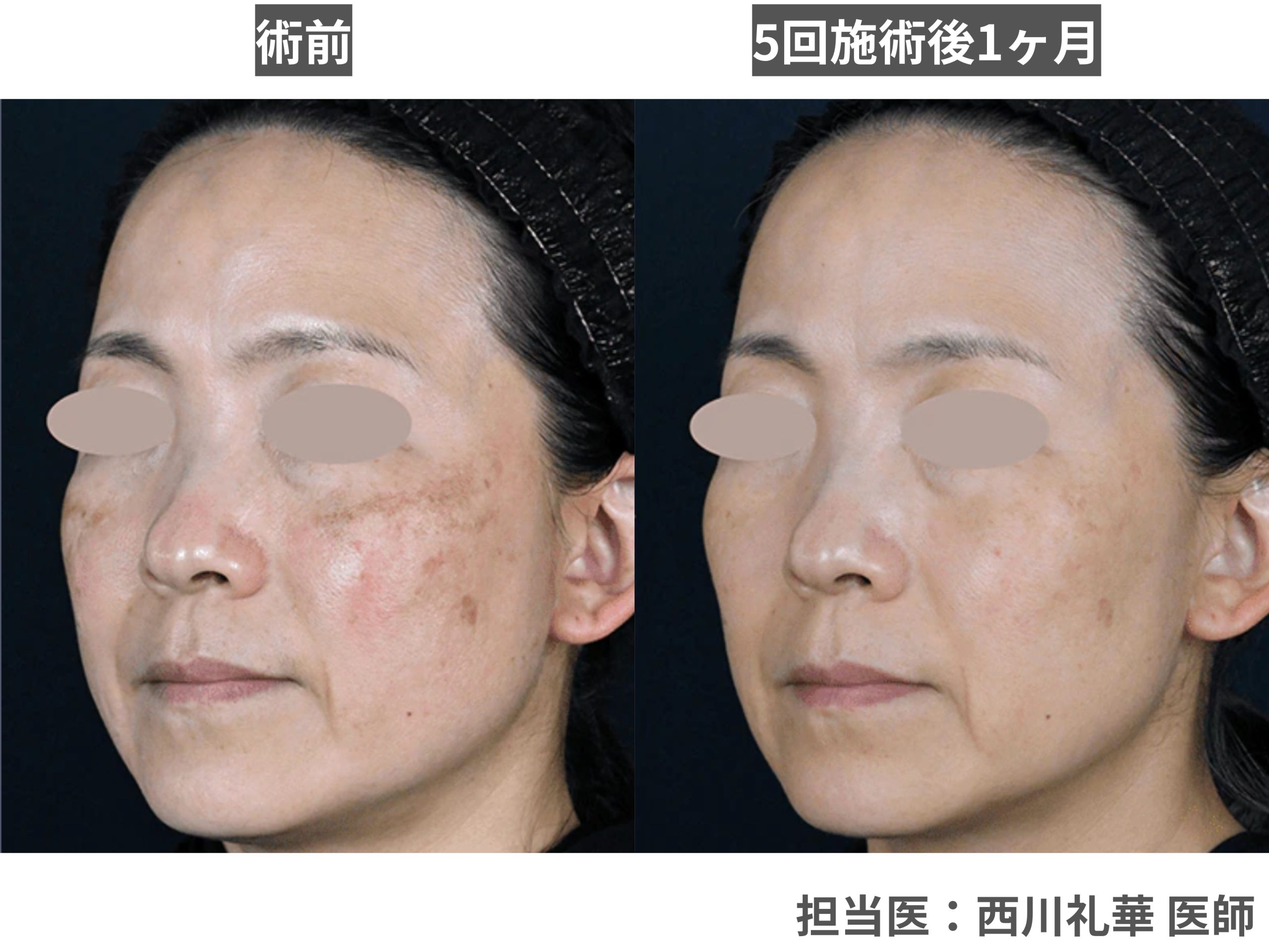 【肝斑】諦めていた「肝斑」や「繰り返す赤み」を「根本から改善したい」方へ