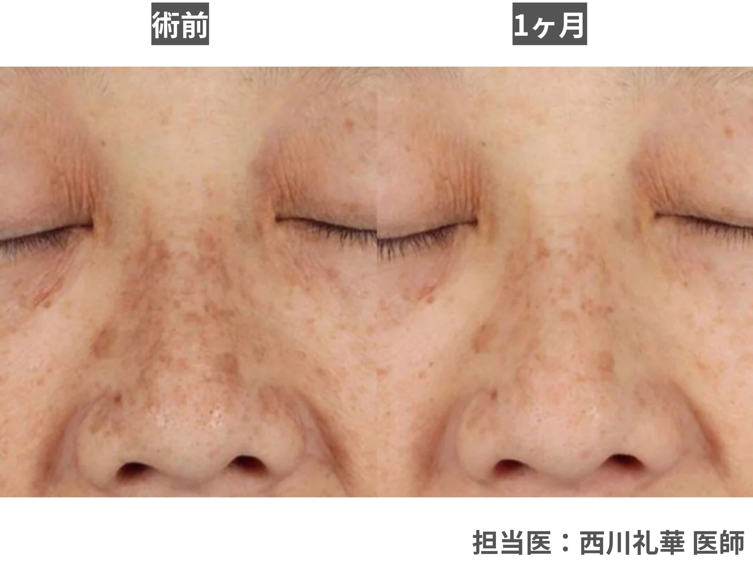 【肝斑】全体的な「肌の色ムラ」を均一にしたい・「肝斑」を徐々に薄くしたい方へ