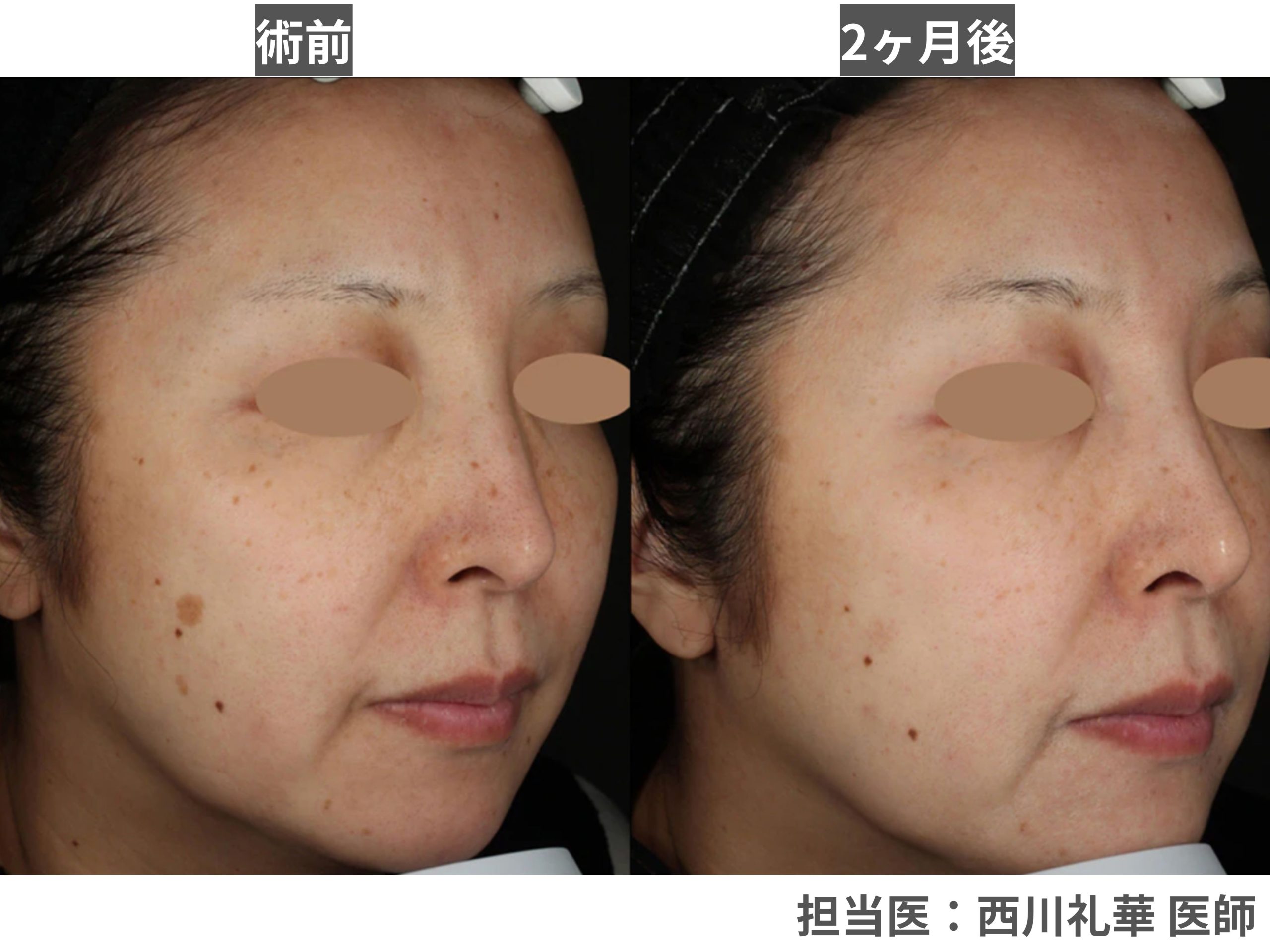 【老人性色素斑】濃いシミ・ピンポイントのシミを早く消したい方へ