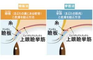 埋没法には2種類ある