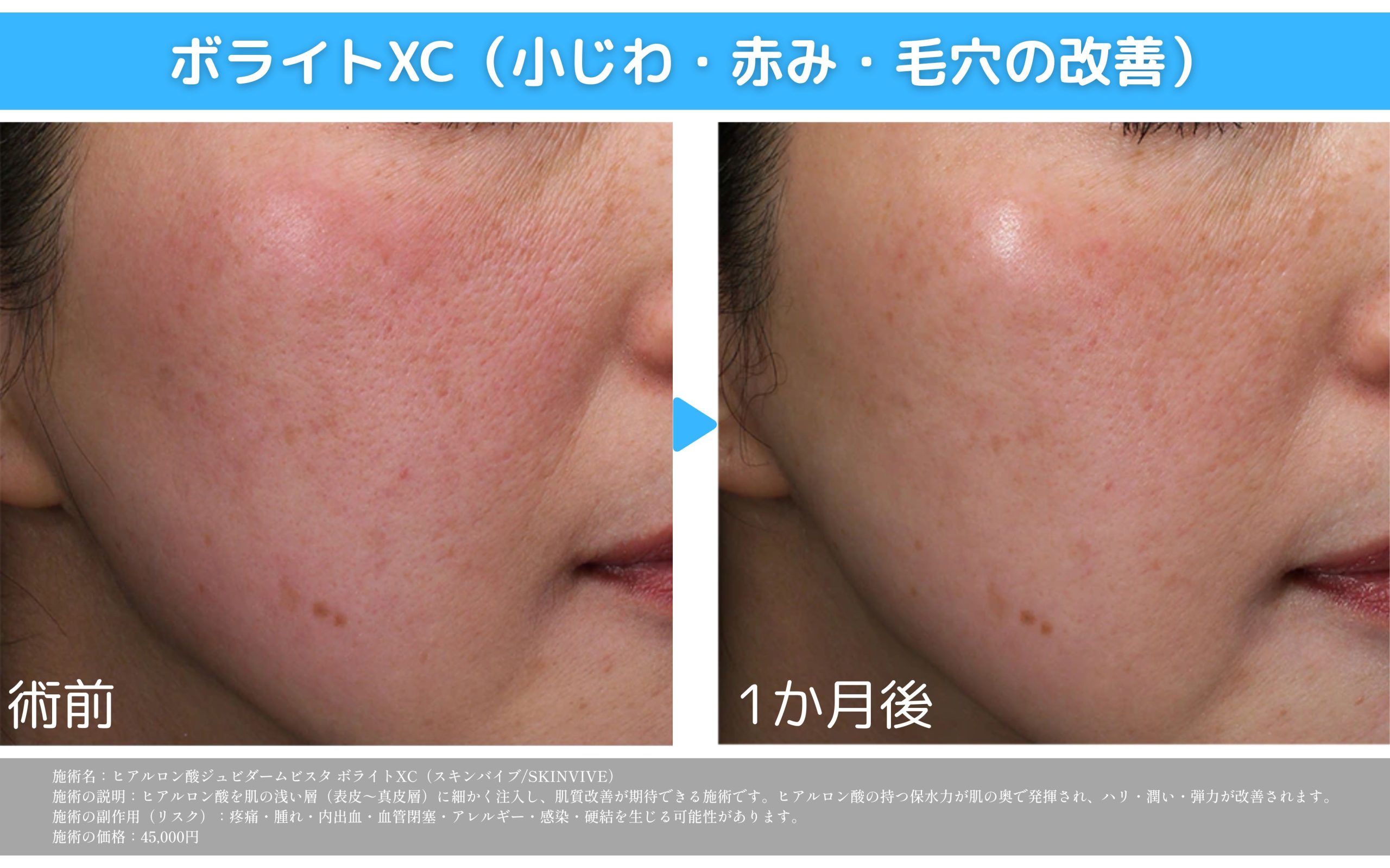 【ボライト】長持ち潤いヴェール🫧✨