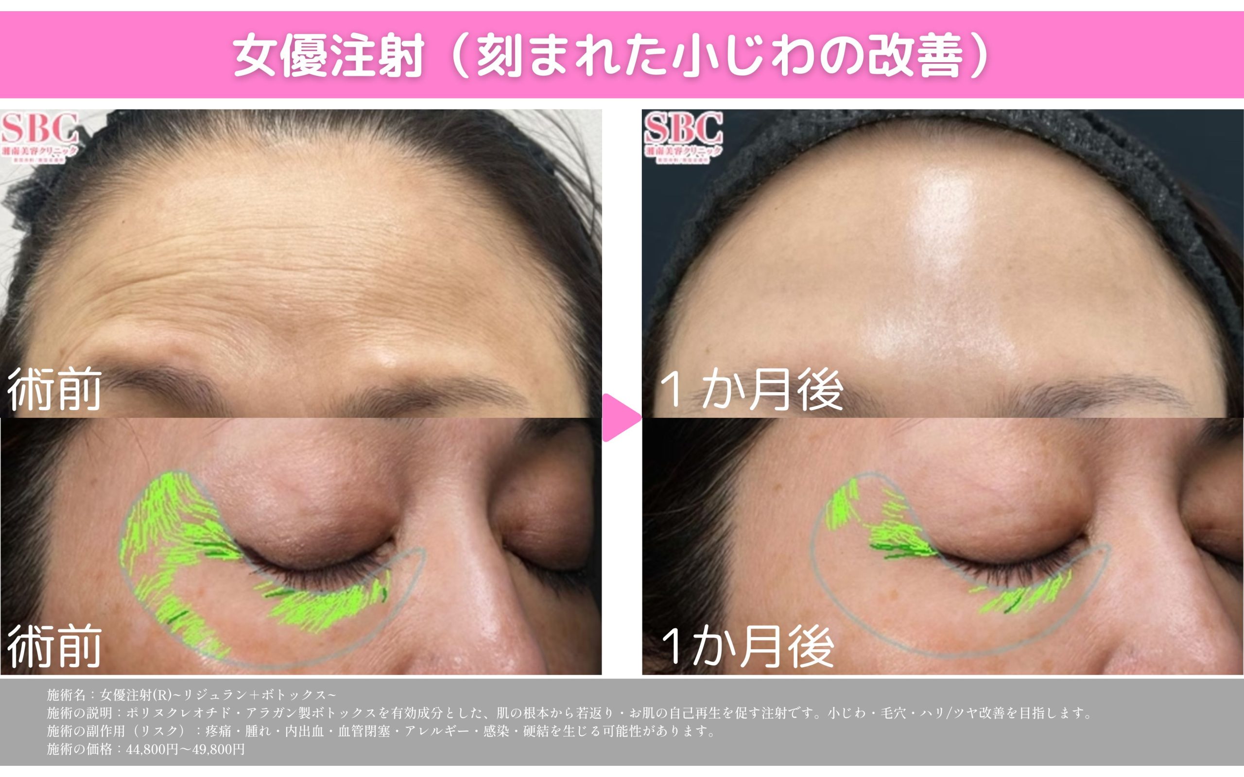【女優注射】リジュラン×ボトックスの最強タッグ💖
