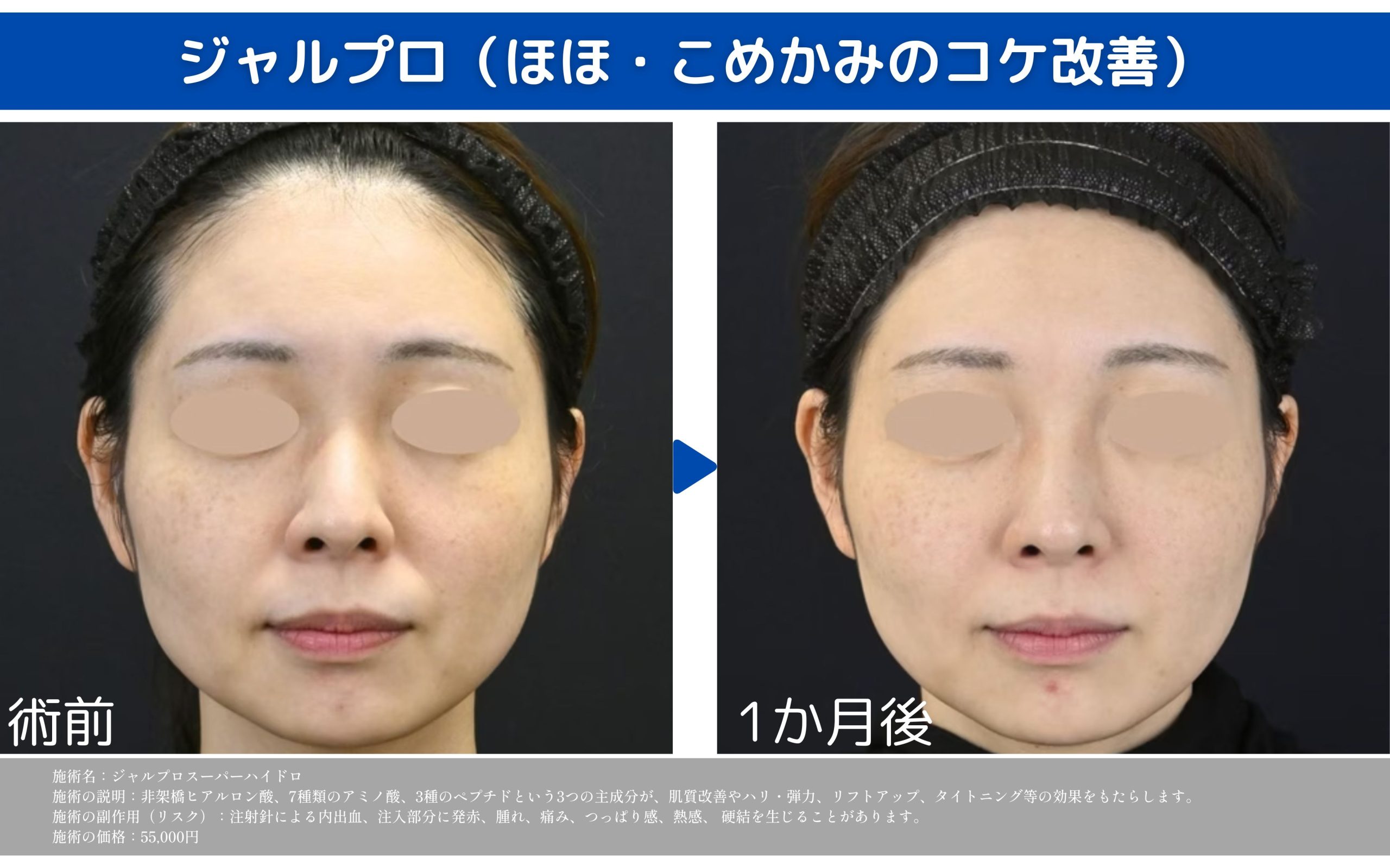 【ジャルプロスーパーハイドロ】お肌の再構築&リフト💉