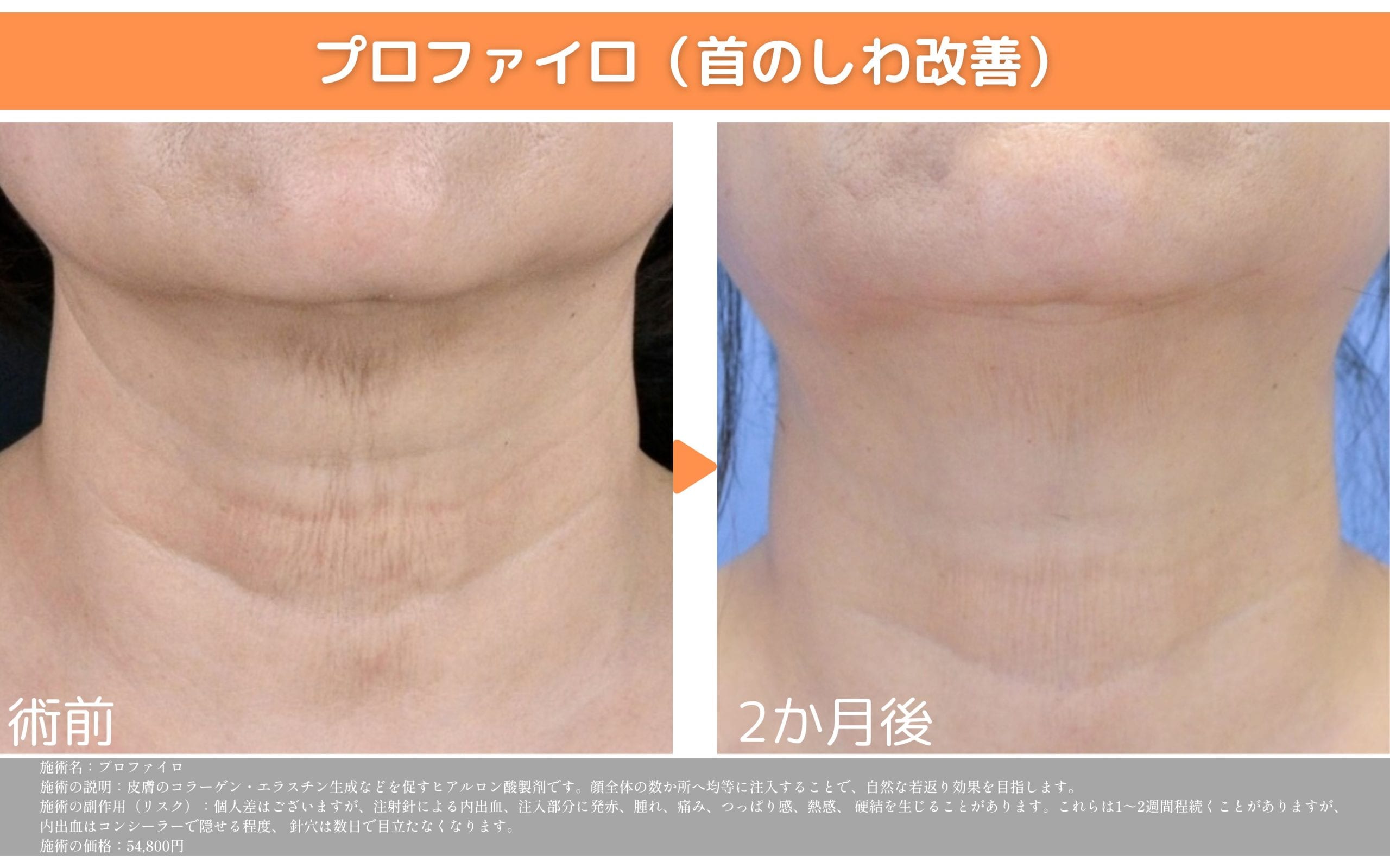 【プロファイロ】次世代のリモデリング製剤✨